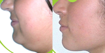 18-24 year old woman treated with Chin Liposuction - 18-24 year old woman treated with Chin Liposuction