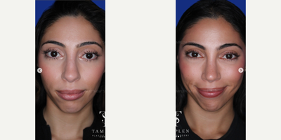 Woman treated with Rhinoplasty - This lovely patient was bothered by her dorsal hump and wide nasal tip. She trusted me with her nose and now is absolutely in love with it from every angle. She wanted an elegant and natural result with a slight feminine slope, and that is exactly what she got!