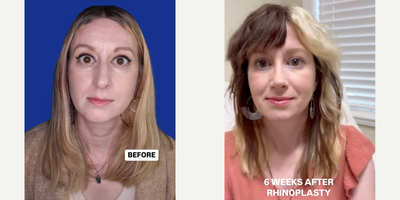 Woman treated with Rhinoplasty - Woman treated with Rhinoplasty