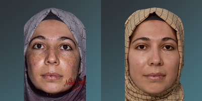 35-44 year old woman treated with Fraxel Laser - 35-44 year old woman treated with Fraxel Laser