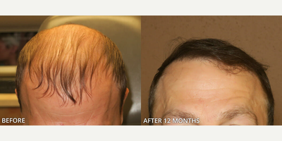 Man treated with Hair Transplant, FUE Hair Transplant - Man treated with Hair Transplant, FUE Hair Transplant