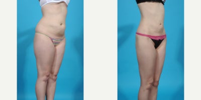 35-44 year old woman treated with Abdominal Etching, Laser Liposuction, Liposculpture, Liposuction, Power-Assisted Liposuction ( - before and after VASER ultrasound assisted liposuction abdomen/flanks; lipo 360. Liposuction is the most popular plastic surgery procedure with about 350,000 procedure done in 2023. Good candidates for liposuction have normal or near normal weight but have discrete problem areas with discrete pockets of fat. Another charateristic of a good liposuction candidate is skin quality. Younger patients with good skin quality and few stretch marks with little to no overhang or excess skin are the best candidates. Vaser is an ultrasound device that melts fat and tightens tissue making liposuction more precise with less bruising and swelling. In this case I did liposuction with VASER assistance removing about 1.5 from her abdomen and flank areas (Lipo 360).