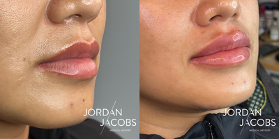25-34 year old woman treated with Lip Fillers - Lip Flip with Smoothing Serum and Filler with RHA Redensity