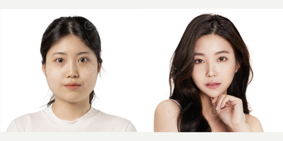 25-34 year old woman treated with Cheekbone Reduction, V Line Surgery - Rhinoplasty, Facial contouring surgery(Jaw reduction, Zygoma Reduction)performed by Seung Ryong Lee MD.