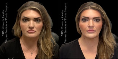 35-44 year old woman treated with Dermal Fillers, Juvederm, Lip Fillers, Vollure, Voluma, Cheek Fillers, Chin Filler - Juvderm filler refresh before and after by VIPS Cosmetic Center at Vinyard Institute of Plastic Surgery in Port Saint Lucie, FL. This female patient was treated with 2cc of Juvderm Voluma to the cheeks and chin for facial balancing, under-eye support, chin refinement, and subtle improvement in submental fullness, along with 1cc of Juvderm Vollure to the upper lip and commissures. Her results show a more balanced facial profile, improved cheek and chin definition, a softened under-eye transition, and refreshed lip shape with better upper-to-lower lip balance, redefined Cupids bow, and added commissure support to help preserve a natural lip contour.