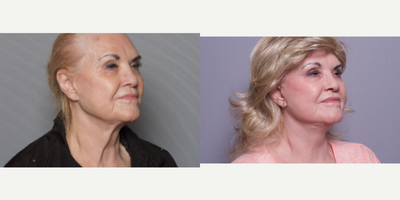 65-74 year old woman treated with Mini Lift - 65-74 year old woman treated with Mini Lift