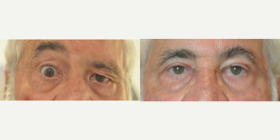 65-74 year old man treated with Brow Lift - Direct left brow lift