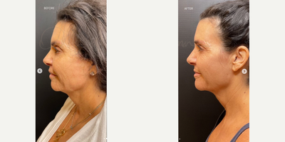 Woman treated with Sylfirm X, Renuva - SylfirmX + Renuva are an excellent combo! Lift, improve texture and tone of your skin with some of our favorite treatments
