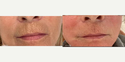 55-64 year old woman treated with Potenza, Microneedling RF - Potenza RF microneedling with PRP. No downtime, slightly red for a few hours after treatment. Minimal discomfort during procedure, no pain after procedure. Numbing cream is optional. Procedure time 30-40 min.