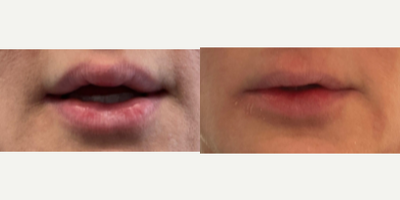 35-44 year old woman treated with Silicone Injection Removal - Patient underwent two rounds of unknown injections about 15 years ago. After noticing some unevenness and lumps on her lips she decided to consult with a board-certified plastic surgeon. After the silicone was removed from her lips patient received one syringe of filler to help give her shape and definition back to her lips 6 months post op her removal procedure. She is now shown 13 months post op.