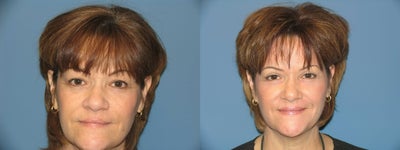 Upper and Lower Lid Blepharplasty - 
	Fran had a Upper and Lower lid blepharplasty to help rejuvinate her eyelids for a more a youthful appearance.
