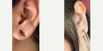 25-34 year old woman treated with Earlobe Repair - Earlobe repair for a patient who has gauges when she was younger, and wanted to go back to having her old lobes. She has a new found confidence and loves wearing different styles of earrings, or none at all where she doesn't have to worry about the stretched holes.