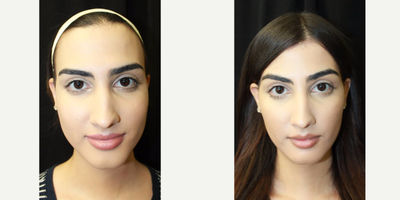 18-24 year old woman treated with Facial Feminization Surgery - 18-24 year old woman treated with Facial Feminization Surgery - Mandible Contouring