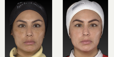 35-44 year old woman treated with HydraFacial, Chemical Peel, Cosmelan, Skin Rejuvenation, Skin Lightening - This patient underwent a combination treatment in which we used Hydrfacial and cosmelan chemical peel (both office and home kit)