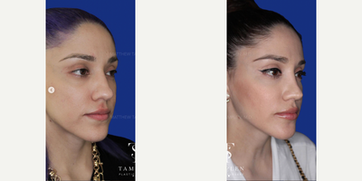 Woman treated with Rhinoplasty - Beautiful results just 7 months following Rhinoplasty.This patient wanted her nose to be more refined while still looking natural and like herself.Following surgery, she is breathing great and loves her new elegant look!