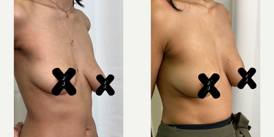 25-34 year old woman treated with Nonsurgical Breast Lift - Non-Surgical BBR (Bilateral Brest Lift) with MINT Threads! The MINT EZ Thread is used to suspend the breasts in 30 minutes without a scapula. Local lidocaine is used to numb the treatment area before gently inserting the MINT PDO Threads beneath and through the breasts. The procedure is minimally invasive, minimal discomfort, and can be done during your lunch break. The results are instant, with dimpling, tenderness and swelling in the treated area for 2-4 weeks. A tight sports bra is required immediately after the procedure, with restrictions of exercise, strenuous activities, saunas and lifting the arms above the shoulders. The results are gentle, natural-looking, scarless and Safe. Results last for 12-24 months.