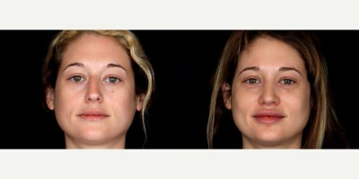 29 year old woman treated with Rhinoplasty, Voluma, Juvederm - 29 year old woman treated with rhinoplasty, 1 syringe of Voluma to cheeks, 1.5 syringe of Juvederm Ultra CX to lips and 0.5 syringe of Juvederm Ultra XC to nasalabial folds. Photos depict before and 3 months after treatment.