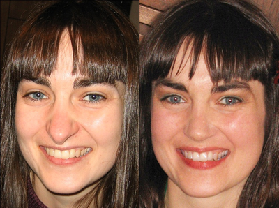 Revision rhinoplasty for a long nose - 
	Her nose was much too long after her primary rhinoplasty. Inadequate work on the tip leaving it too long or too projecting forward is the most common error I see from previous rhinoplasties.
