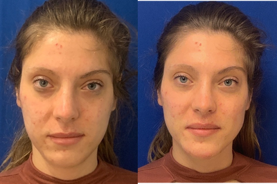 Woman treated with Radiesse - My patient desired a more chiseled chin and jawline. I used 2 Radiesse on the chin and jawline and Restylane Lyft to her cheekbones.