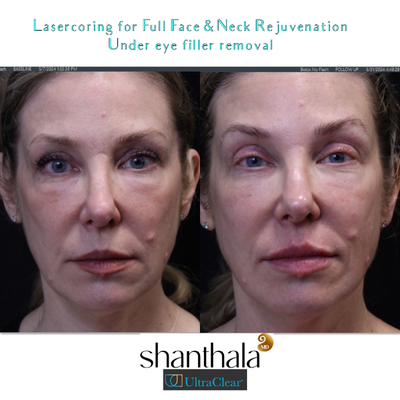 35-44 year old woman treated with Laser Resurfacing, Fractional Laser, Hyaluronidase - Reversal of Under eye fillers & Laser-coring with Ultraclear