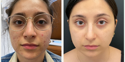 18-24 year old woman treated with Fraxel Laser - This patient came to us with concerns about acne and acne scarring. After undergoing Fraxel treatment, their skin is now smoother, clearer, and significantly rejuvenated. Fraxels advanced laser technology targets deep scars and uneven texture, providing remarkable results.