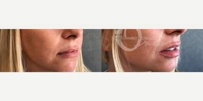 Woman treated with Injectable Fillers - Woman treated with Injectable Fillers to lips