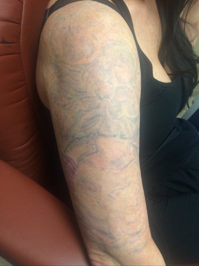 GO Tattoo Removal в Twitter MASSIVE results after 3 treatments on this  half sleeve  weve also started working on the rest of the sleeve and will  post updates later  