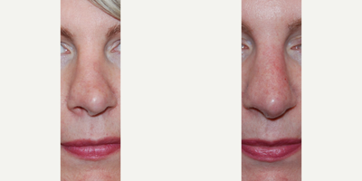35-44 year old woman treated with Nonsurgical Nose Job, Silikon 1000 - This is an example of a permanent non-surgical nose job to create a straighter nasal appearance and to camouflage a profile bump after previous rhinoplasty surgery was performed elsewhere. Results were achieved after two treatments with microdroplet Silikon-1000. Unlike gel fillers, Silikon-1000 is completely permanent and is not associated with serious complications like: blindness, embolism, necrosis, stroke, or biofilm.
