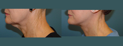 65-74 year old woman treated with Neck Lift, Facelift - This 65 year old woman is seen prior to and nine months following face and neck lift.