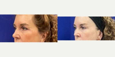 65-74 year old woman treated with Agnes RF - Upper Eyelid tightening