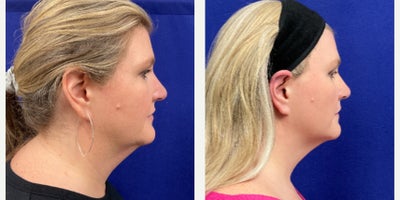 45-54 year old woman treated with Agnes RF - Submental debulking and jawline tightening