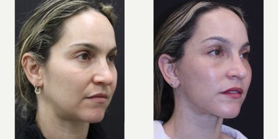 35-44 year old woman treated with Deep Plane Facelift, Endolift, Laser Resurfacing, Facial Fat Transfer - Comprehensive Facial RejuvenationFacial rejuvenation isn't about waiting until you need itit's about preserving what you love before more significant changes occur.This patient chose a comprehensive approach designed to restore youthful contours, improve skin quality, and maintain natural facial expression while aging gracefully.The procedures included: Deep plane face & neck lift Endoscopic brow lift Full-face Erbium laser resurfacing Structural fat graftingRather than chasing dramatic change later, early intervention often allows for more refined, longer-lasting, and naturally elegant results. The goal is never to look differentit's to continue looking like yourself, simply refreshed.Every treatment plan is individualized based on anatomy, skin quality, and each patient's unique goals.Procedures: Deep Plane Face & Neck Lift  Endoscopic Brow Lift  Full-Face Erbium Laser  Fat Grafting