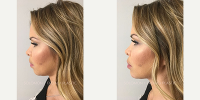 Botox - This female patient in her late 30s wanted more definition in her chin and chose to undergo a non-surgical chin augmentation using dermal filler. Her results were achieved using 3 syringes of Teosyal, Redensity II and Ultra Deep.
