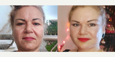 Woman treated with Cheek Augmentation - Woman treated with Cheek Augmentation through facial fat transferas well asDeep Plane Facelift, Eyelid Surgery,Neck Liftand Facial Fat Transfer, shown 3 months post op. Pre-op, she wasn't happy with her appearance and wanted to look younger.