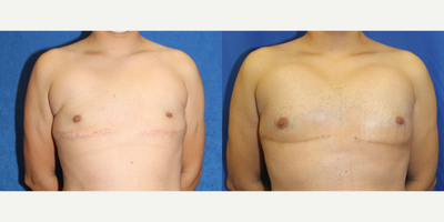 35-44 year old man treated with Pec Implants - This is a 37 year old male patient who is 5'5 and 145 pounds. In 2007, he had raw silicone injected in his pectoral area which caused him problems. In November 2021, this patient traveled from Chicago to Beverly Hills to have Dr. Katzen remove the silicone. Later, this patient returned to Dr. Katzen to have pectoral implants. This patient is pleased with his results.