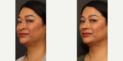 45-54 year old woman treated with Rhinoplasty - female rhinoplasty