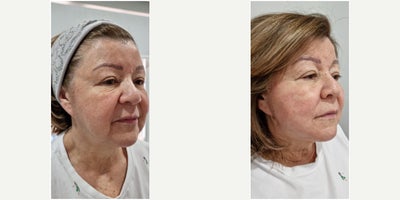 65-74 year old man treated with Thread Lift - Thread lift