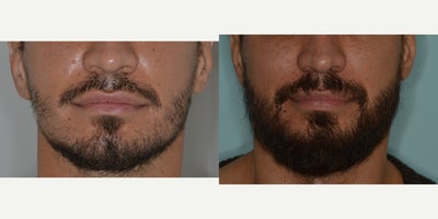 35-44 year old man treated with Beard Transplant, FUE Hair Transplant - Before and after 1800 FUE to beard
