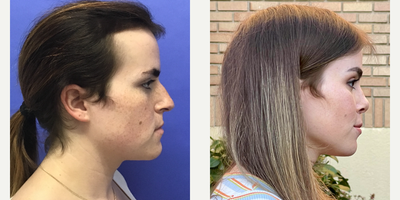 Patient treated with Facial Feminization Surgery, Transgender Facial Feminization Surgery, Rhinoplasty, Septoplasty, Cheek Augme - 25 to 34 year-old female patient is 1 year post-op from Facial Feminization surgery. Her procedures included: Forehead Lift, Hairline Lowering, Orbital Bony Contouring, Septorhinoplasty (open) with Cartilage Grafts and Weirs, Cheek Implants (small combined), 2 cc Voluma to Medial Cheeks, Chin Reduction and Contour, Thyroid Cartilage Shave, Intranasal Lip Lift with Fat Augmentation, Soft Tissue to Nasolabial Folds, and 300 Micrografts to the Fronto Temporal Recessions.