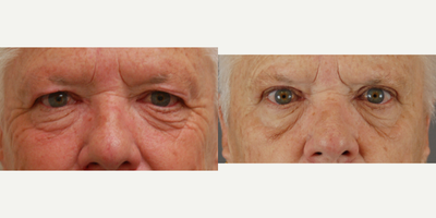65-74 year old woman treated with Eyelid Surgery - Upper eyelid surgery performed by Dr. Bryson Richards. Nothing done to the lower eyelids.