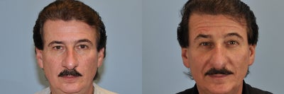59 Year Old Male Treated for Nose Resurfacing  - 
	This Mentor area man underwent a rhinoplasty. Rhinoplasty means to restructure the nose, or to change the shape.
