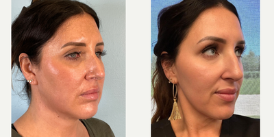 25-34 year old woman treated with Buccal Fat Removal, Chin Implant, Jawline Sculpting, and nose threads - Cheekago with nose threads!