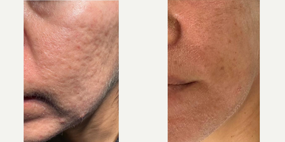 Woman treated with MiXto Laser, Fractional Laser, Laser Resurfacing, Sculptra - Mixto fractional CO2 laser resurfacing plus Subcision plus Sculptra Fillers. This is the immediate after treatment photo. Some of the visible improvement is due to swelling. A portion of the scars will reappear as the swelling subsides & the skin heals. But then, over the next 3 to 4 months, the rolling & atrophic scars will fill-in from underneath. One treatment usually results in 25% to 30% improvement . Sculptra has the benefit of lasting for 5 to 7 years.