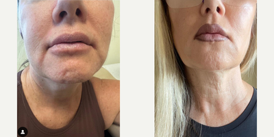 Woman treated with Juvederm, Restylane, Dermal Fillers, Ultherapy - Marionette lines can make the facial expression appear sad or even angry. Juvederm & Restylane fillers & Ultherapy can help!