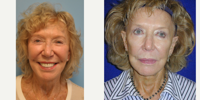 75 and up year old woman treated with Sculptra - 83 year old female treated with Sculptra.
