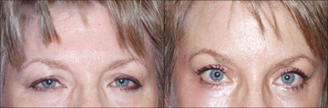 Removing wrinkles from brow area - 
	With wrinkles starting to show, the patient was concerned about the compounding effects of age. During her consultation, a brow lift procedure was determined to be the best choice for restoring a more youthful look to her face. The results were a lifted brow area, smoother forehead, and younger, nicer appearance.
