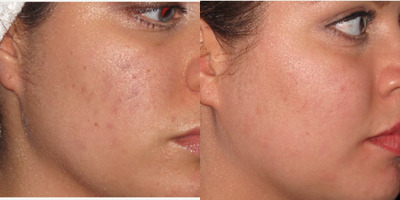18-24 year old woman treated with Pixel Laser - Pixel ER to acne scarring