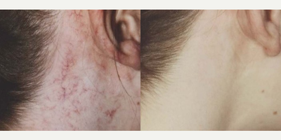 Woman treated with Pulsed Dye Laser - Woman treated with Pulsed Dye Laser