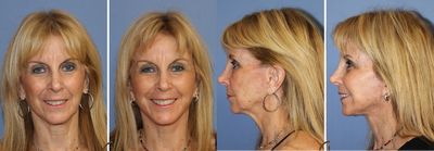 Fat grafting to the face as a permeant filler - replenish lost facial volume  - This patient had lost a lot of facial volume due to aging.  She had tried derma fillers in the past but was unhappy with the short amount of time that they had lasted.  Board certified facial plastic surgeon, Dr. Kevin Sadati, suggested fat grafting (also known as a fat transfer or fat injections) for this patient.  Fat grafting is performed in office, under local anesthesia and twilight sedation.  The procedure itself utilizes liposuction in order to remove unwanted fat from the patients body. Which is often taken from places like their stomach, butt or thighs.  This fat is then used as a permeant filler, restoring lost facial volume to areas such as the patient's cheeks, temple area and lips. &nbsp;