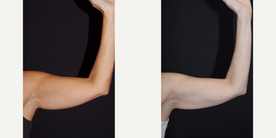 45-54 year old woman treated with Venus Legacy (and CoolSculpting) - 48 year old female received CoolSculpting and Venus Legacy to the arms; photos depict the patient's results 6 months post-CoolSculpting and 3 months post-Venus Legacy.